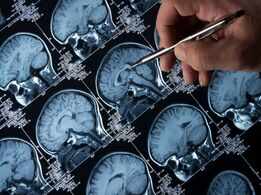 Brain Tumour