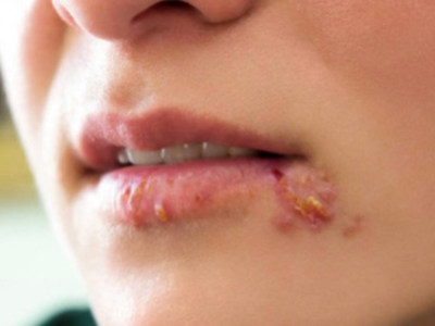 What is Herpes and how is it cause? Here's everything you need to know