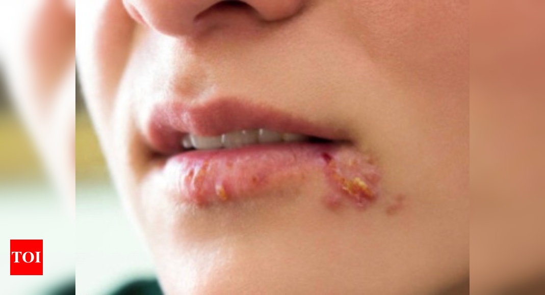 To you rid what herpes do of get can Herpes: Symptoms,
