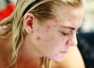 Is aspirin really effective on acne and scars?