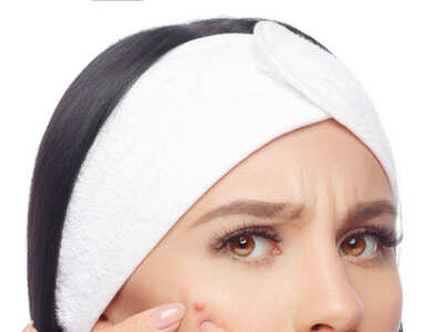 Home remedies to remove pimple marks