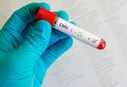 Coronavirus: What is Cytomegalovirus? How is it affecting COVID-19 patients?
