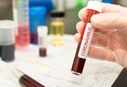 COVID-19 infection significantly changes our blood cells: Study