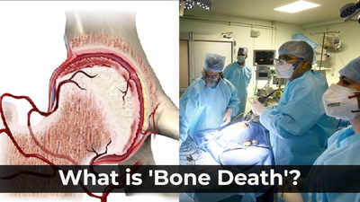 Explained: Why 'bone death' is worrying doctors treating long-Covid patients