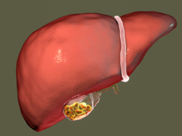 Gallbladder stones