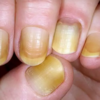 How long does it take 'terry's nails' to go away? - Quora