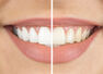Homemade ayurvedic powder for teeth whitening