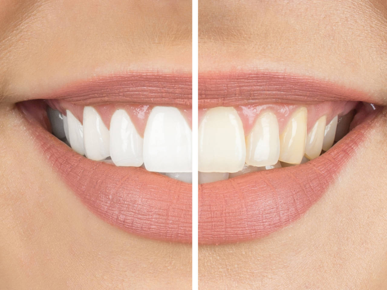The Truth about Teeth Whiteners - Should You Be Using Them?