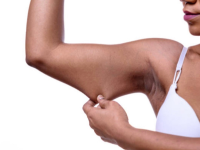 Taking care of sagging skin post weight loss