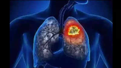 HRCTs for Covid detecting early-stage lung cancer