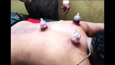 Aurangabad ZP first to offer Unani cupping therapy at dispensaries