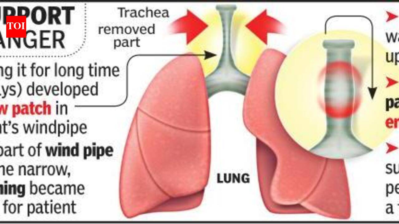 Windpipe damaged due to ventilator repaired in rare surgery | Nagpur ...