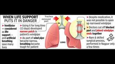 Windpipe damaged due to ventilator repaired in rare surgery | Nagpur ...
