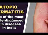Atopic dermatitis: One of the most underdiagnosed skin diseases in India