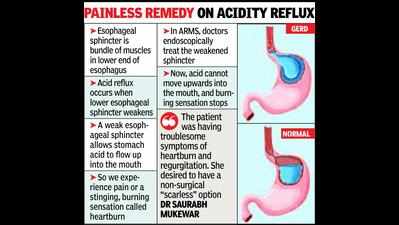 Acidity reflux treated endoscopically in first ARMS process of Central India