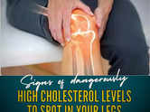 Signs of dangerously high cholesterol levels to spot in your legs