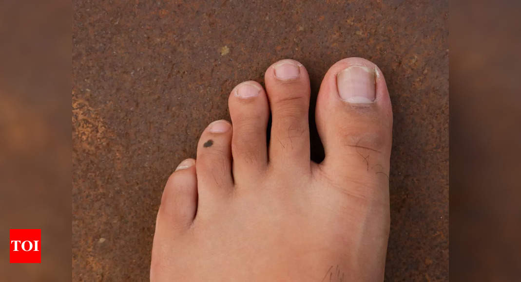 Toenail Problems: Causes, Symptoms, and Treatments