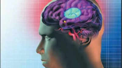 Stroke: In a minute 1.9 million brain cells die - Times of India