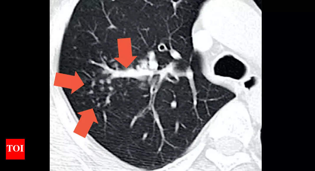 New Corona Cases Have Lesser Lung Involvement Experts Ahmedabad News