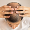 7 Stages of Male Pattern Baldness Male Balding Patterns 101