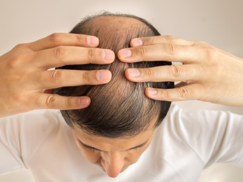 Are you experiencing hair loss after weight loss? Know why | The Times of  India