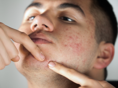 Study provides insight on new acne risk genes and hope for new treatment
