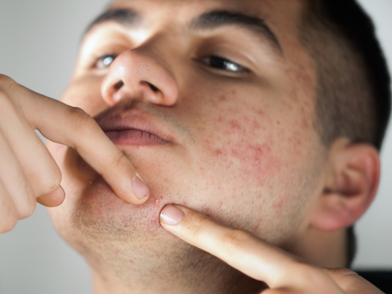 Study provides insight on new acne risk genes and hope for new treatment -  Times of India