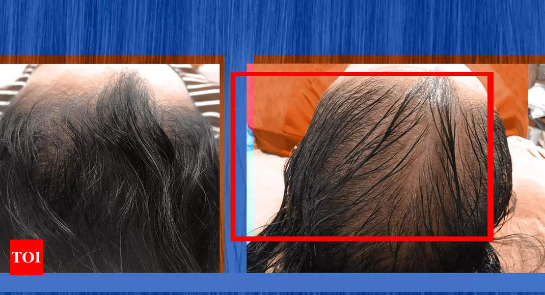 How hair loss is wrecking lives of Covid patients | India News - Times of  India