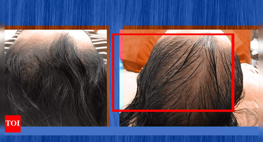 How hair loss is wrecking lives of Covid patients | India News - Times of India How hair loss is wrecking lives of Covid patients | India News - Times of India