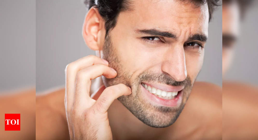 How to treat itchy beard – Times of India