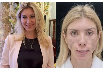 With plastic surgery gone wrong, Russian beauty queen left disfigured!