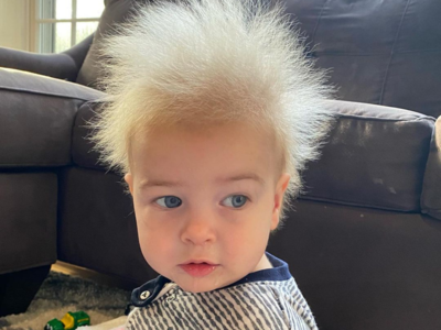 Unusual hair condition made this 14 months old boy an Instagram hit! Know what’s his condition