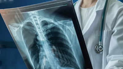 Post-Covid effect: Rise in severe tuberculosis cases in Indore district