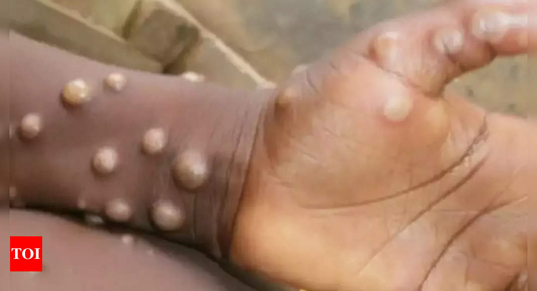 monkeypox:  England detects four more cases of monkeypox infection – Times of India