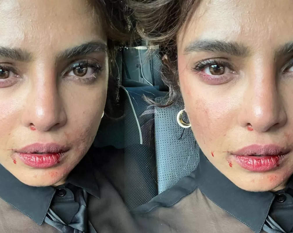 
Priyanka Chopra Jonas' bruised face from the sets of 'Citadel' leaves fans worried for her
