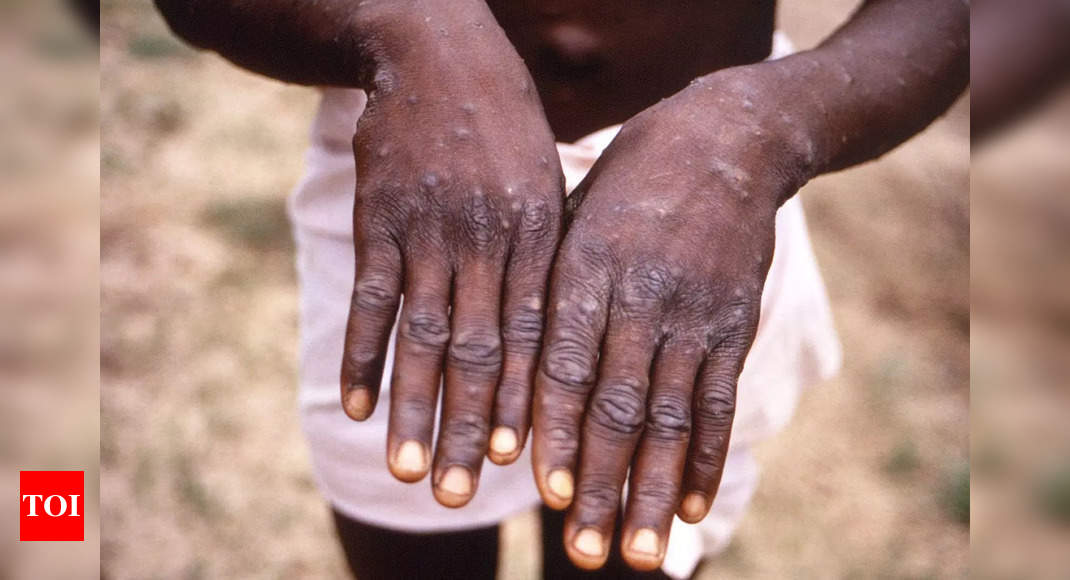 Rare monkeypox outbreaks detected in North America, Europe