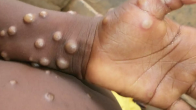 Australia reports first monkeypox case in traveller from Britain