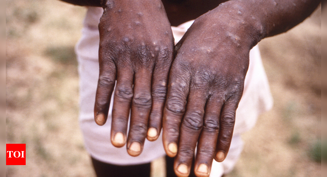 Europe health official warns monkeypox cases could ‘accelerate’ – Times of India