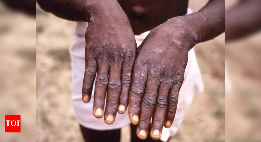 WHO calls emergency meet as monkeypox cases rise