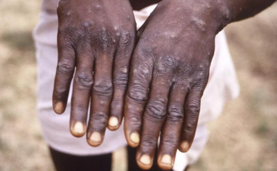 Biden: Monkeypox threat doesn't rise to level of COVID-19