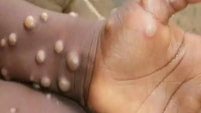 No evidence monkeypox virus has mutated, says WHO: Key developments