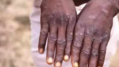 No immediate need for mass monkeypox vaccinations: WHO official