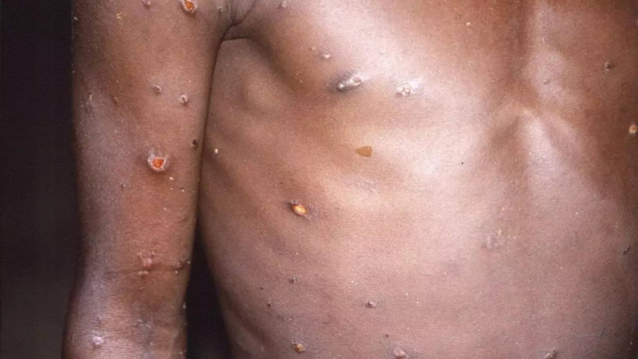 Over 100 monkeypox cases confirmed in 20 countries: Key points - Times of  India