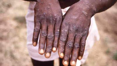 Monkeypox cases around the world