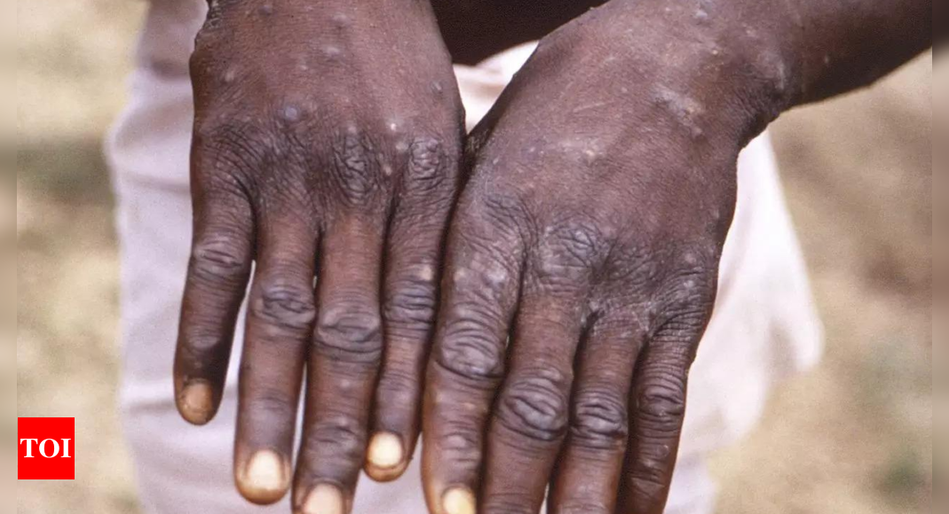 Monkeypox: Nigeria confirms 21 cases of monkeypox since January