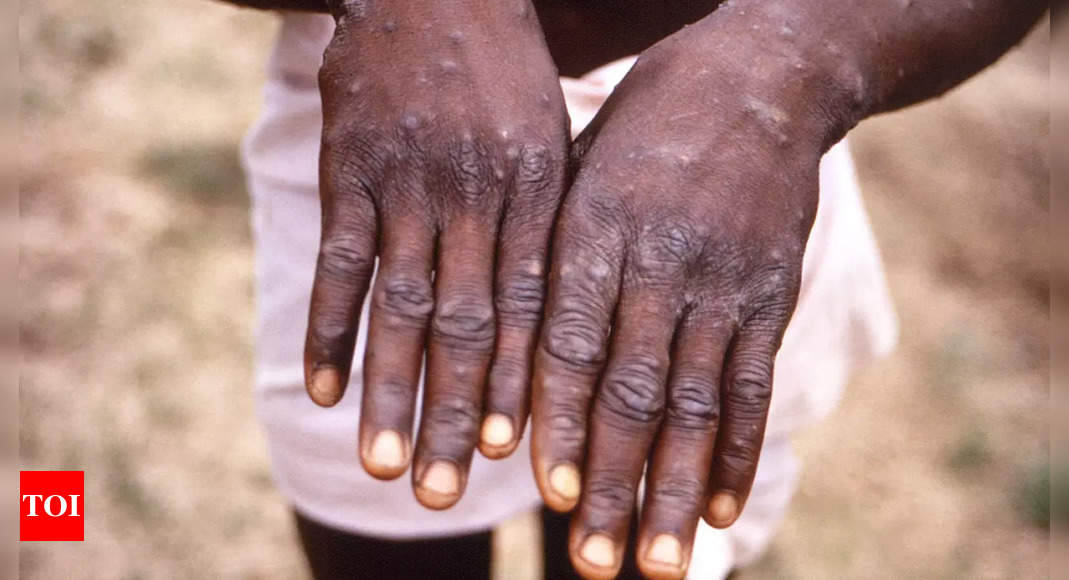 Take even 1 case as an outbreak: Government’s guideline on monkeypox | India News – Times of India