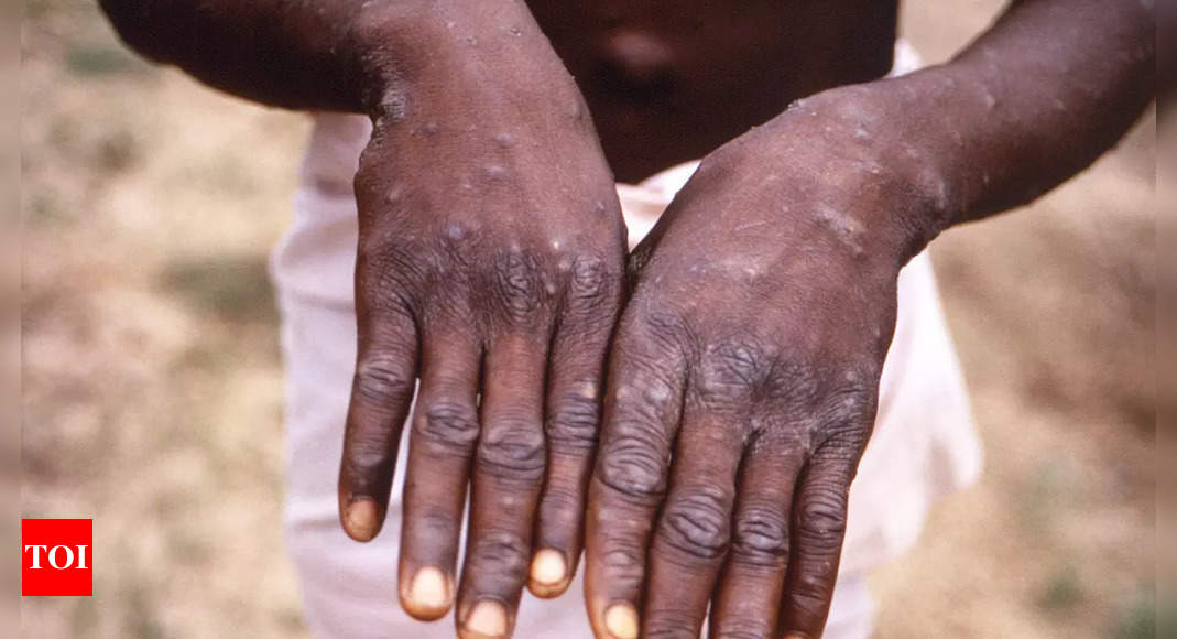 Italy’s monkeypox cases rise to 20, will increase further, says deputy minister – Times of India