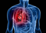 THIS common sign can indicate lung cancer