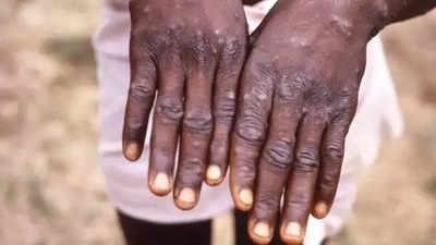 WHO drops endemic country distinction for monkeypox