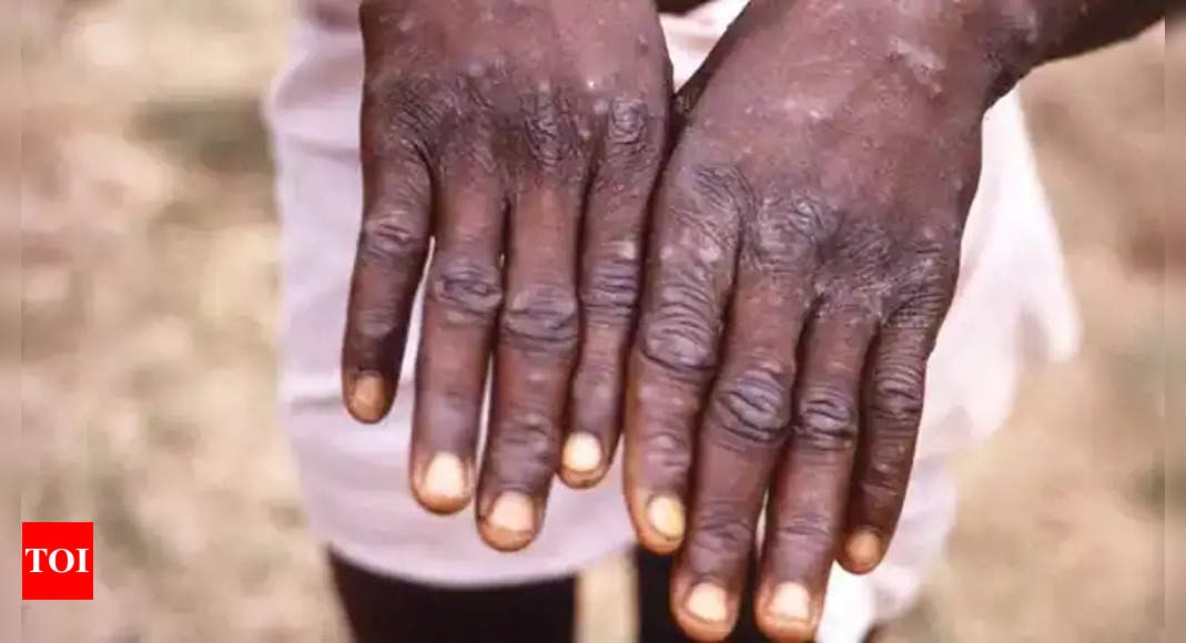 WHO drops endemic country distinction for monkeypox – Times of India